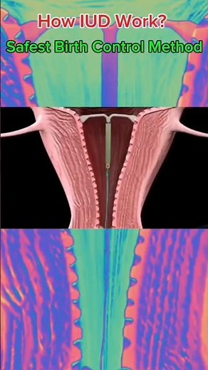 How Does the Female Intrauterine Device (IUD) Work? | Hormonal vs Copper IUD Explained!
