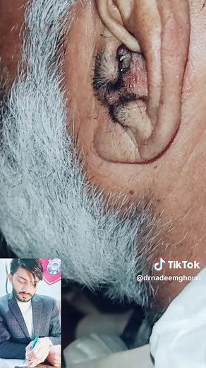 #entclinic02 👂 Ear wax