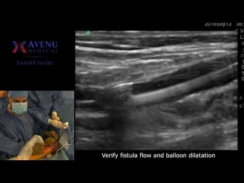 Percutaneous AV Fistula Creation - Ellipsys Avenu Catheter