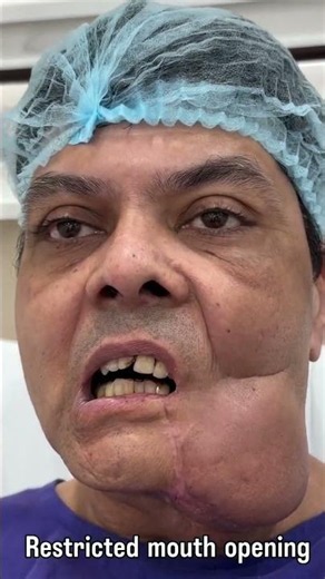 Surgery day ( Post - CA patient ) - Resection and Reconstruction surgery
