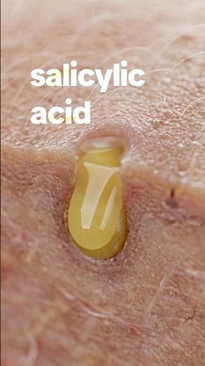 Salicylic Acid for Skin: What It Really Does