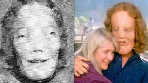 Tragic real life story of boy whose rare deformity inspired the famous film 'Mask'