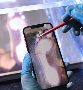 Amazing Flat Feet Diagnosis Explained | 5-Minute Workouts