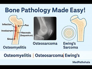 Lesson 52 | Bone Pathology | Osteomyelitis & Bone Tumors (Osteosarcoma, Ewing’s) | FMG/BHMS/MBBS