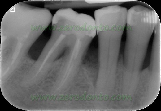 Minimally Invasive Surgical Technique (MIST) In Regenerative Periodontal Therapy | Zerodonto | Dentistry in Blog