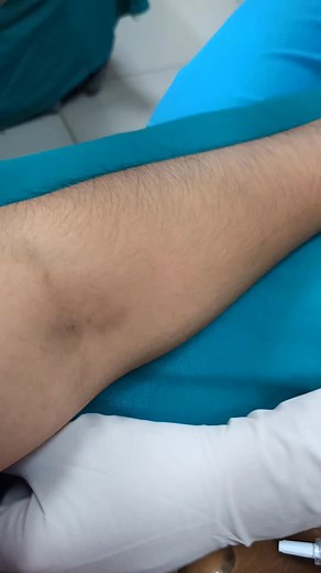 Canalización de Vía Periférica para Ciclofosfamida