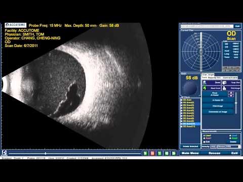 Accutome B-scan Plus - Vitreous Hemorrhage