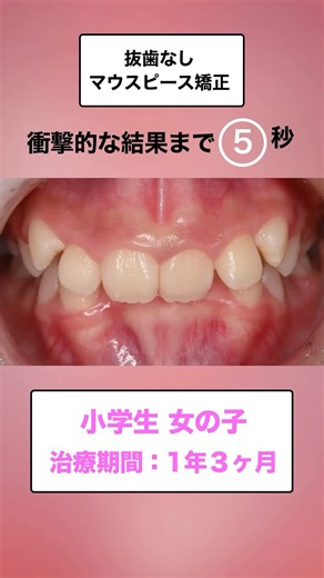 斎藤秀也【マウスピース矯正医】さいとう矯正歯科 Dr.Saito Shuya on Instagram: "🌟マウスピース矯正はできないと言われた歯並びも治ります🌟 治療をする歯科医師の技術で治療結果は圧倒的に変わります。 日本全国でマウスピース矯正で歯並びを治したい患者様は 🌟さいとう矯正歯科 札幌本院🌟 🌟銀座さいとう矯正歯科🌟 🌟福岡天神さいとう矯正歯科🌟 までご予約お待ちしております😌 現在多くのご予約を頂いております🌟 無料相談も行っておりますので、プロフィールからホームページをご覧ください✨ #国内症例数No1のクリニック #レッドダイヤモンドプロバイダー (世界最高ランク 日本で５名) #マウスピース矯正 #インビザライン #invisalign #スピード矯正 #無料相談受付中 #歯列矯正 #歯並び #矯正歯科 #札幌矯正 #札幌矯正歯科 #札幌矯正歯科人気 #銀座矯正歯科 #銀座矯正歯科人気 #福岡矯正歯科 #福岡矯正歯科人気 #さいとう矯正歯科札幌本院 #銀座さいとう矯正歯科 #さいとう矯正歯科福岡天神院"