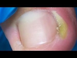 Small Ingrown Toenail Causes Abscess On Toe, Treatment【Crazy pedicure room】