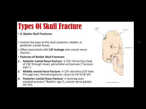 Fractures Of Skull