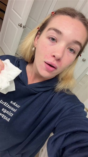 BAYYY (@baylendooley)’s video of perioral dermatitis