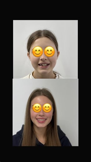 Анастасія Сергіївна on Instagram: "Перевтілення посмішки😍 Не простий кейс ,але ми впорались ✅ Було проведено : 1.Видалення 8-х зубів (зуби мудрості) 2.Дисталізація за допомогою апарату “Distal Jet” 3.Дисталізація до мікроімплантів 4.Індивідуальні дуги в техніці MEAW Гарна посмішка -це взаємодія і сумлінна праця лікаря і пацієнта ,без виконання рекомендацій і гарного домашнього догляду пацієнта гарний результат отримати неможливо . Дякую за довіру ❤️#ортодонтіяукраїна #стоматологія"