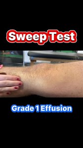 Sweep Test for Joint Effusion [Meniscus, ACL Diagnosis] Grade 1 | Fitness Pain Free
