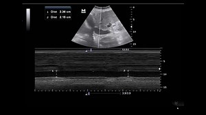 What is the main cause of respiratory distress? Register in our recorded online course to learn so many critical care U/S tricks which will change your way of management and boost your ICU skills. We are continuously upgrading our courses., so you will expect new lectures to be added to your course from time to time. Attention please, now the complete Lower Limb arterial and venous Doppler course is added to our recorded critical care U/S from basic to advanced course. Also, 25 new lectures were