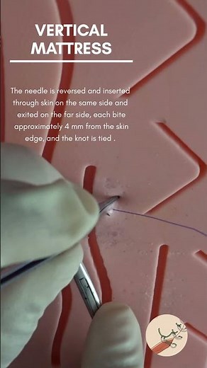 vertical mattress suture | vertical mattress pattern