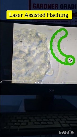 Laser Assisted Hatching in IVF #ivf #embryology #doctor #ivfprocess #ivfprocedure #dailyshorts