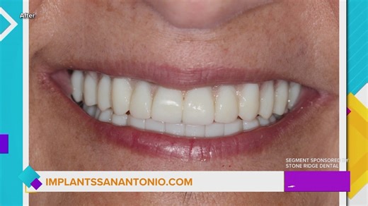 A Full Mouth Transformation with Stone Ridge Dental | Great Day SA