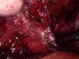 Cecum and Pelvic Volumous Endometriosis • Video • MEDtube.net