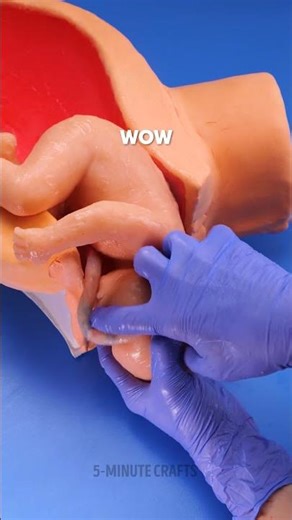 Safe Birth Simulation: Handling a Nuchal Cord During Delivery 🩺🤱