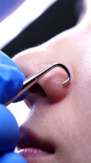 Satisfying Nose Crease Cleaning ✨💆‍♀️