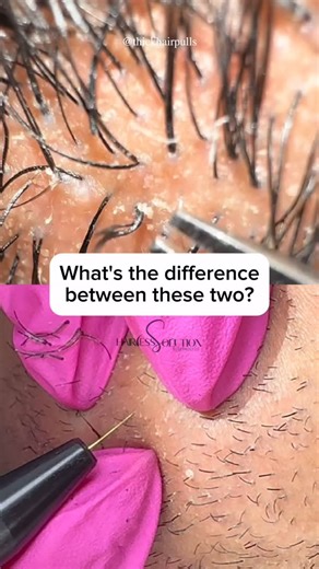 Hairless Solution Electrolysis on Instagram: "Tweezing is temporary. Electrolysis is forever. Choose the solution that lasts! #electrologist #pcos #reels #laserhairremoval#fyp #esthetics #explorepage #hormonalacne #viralreels #foryou #electrolysisatlanta #electrolysis #hairlesssolution #electrologist #atlelectrolysis #georgia"
