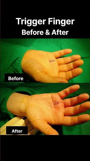 Right Ring Finger Stuck When Bending?