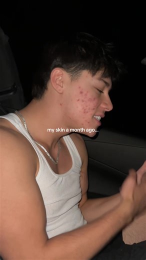 Effective Ways to Balance Hormones for Clear Skin