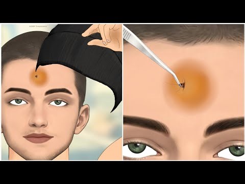 ASMR Animation |🪳 Cockroach Removal From Forhad Satisfying Animation #asmr