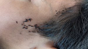 55K views · 566 reactions | A138- Remove all big head lice from head | Popular Videos | Facebook