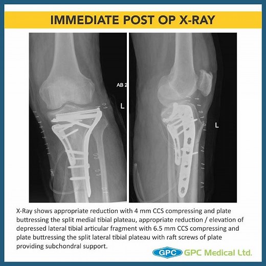Tibial Plateau Fractures: Management technique for Schatzkers type 5 fracture | GAITS Academy