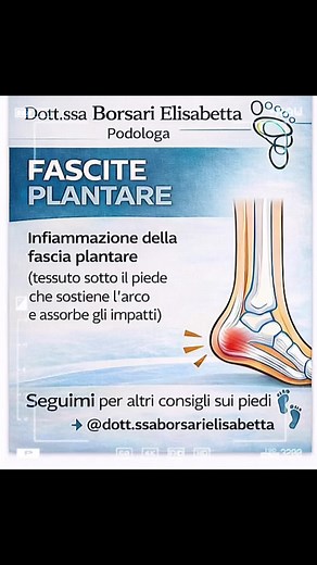 Fascite Plantare: Sintomi e Cura Efficace