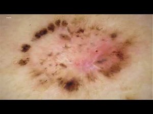 TADA algorithm: skin cancer basics - Dr. Natalia Jaimes