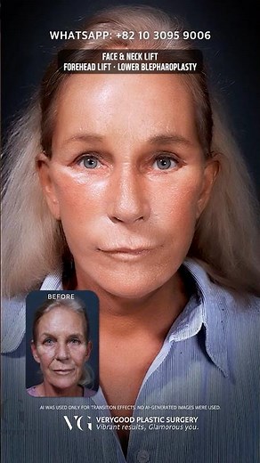 Before & After: 3 Anti-Aging Procedures | Face & Neck Lift+Forehead Lift+Lower Eyelid Blepharoplasty