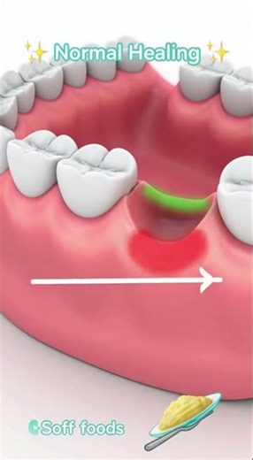 🦷 Swollen Gums After a Tooth Extraction? This Is Often Normal.
