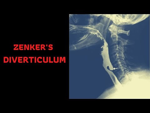 ZENKER'S DIVERTICULUM: Symptoms- Causes- Treatment-Complications