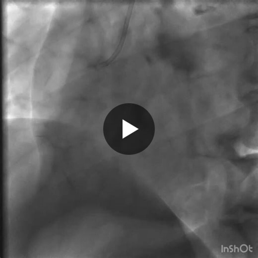 #cardiology #interventionalcardiology #pci #bifurcationpci #leftmain #ivl #radialaccess #cathlab #cardiology #interventionalcardiology #cathlab #pci #complexpci #highriskpci #bifurcationpci… | Amir Chegini