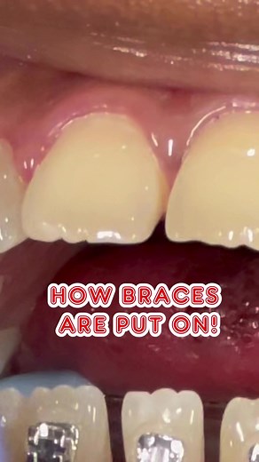 How Traditional Metal Braces Are Applied Step-by-Step