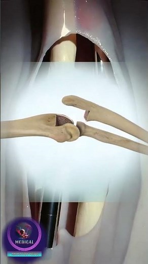 🦾 Total Elbow Replacement: Restoring Motion and Stability