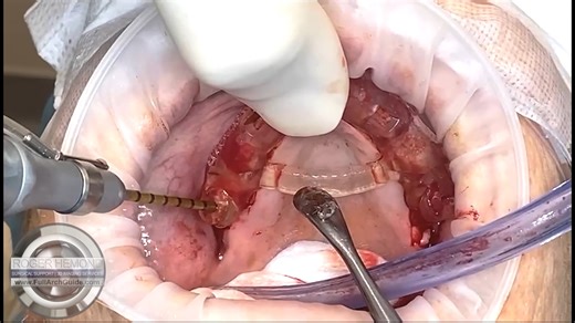 Guided Pterygoid Implant Surgery - Severely Atrophic Maxilla, Quad Zygo Avoided