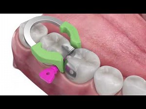 Triodent V3 Sectional Matrix System: Award-Winning Solution for Reliable Class II Restorations