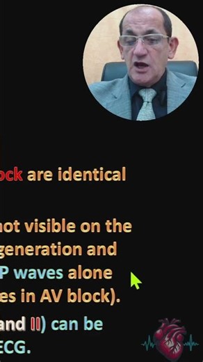 SA EXIT BLOCK ECG DIAGNOSIS (28)
