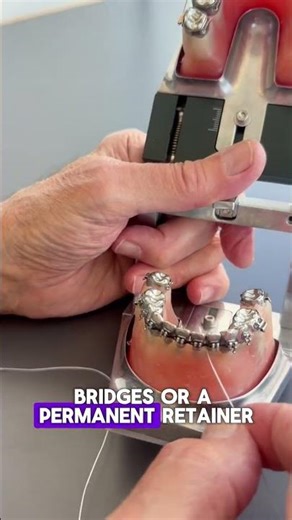 How to Floss Under Braces, Retainers, and Bridges with Superfloss