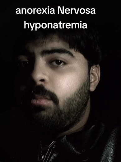 ‏anorexia Nervosa hyponatremia #medicine #medicalstudent #usmle