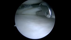Complex Meniscus Tear repair with Novostitch Plus