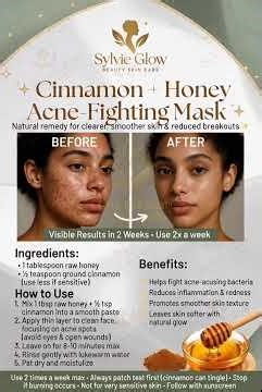 DIY Cinnamon Honey Face Mask for Acne & Smooth Skin (Beginner Friendly)