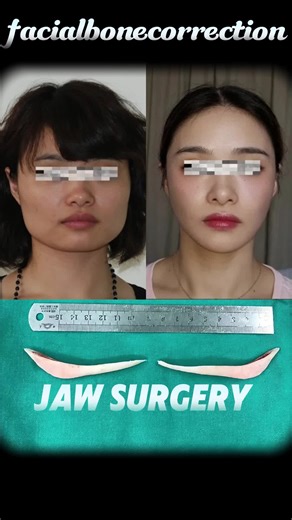 Jaw surgery, 3D animation demonstration#faceshape #jaw #bone #surgery #smallface