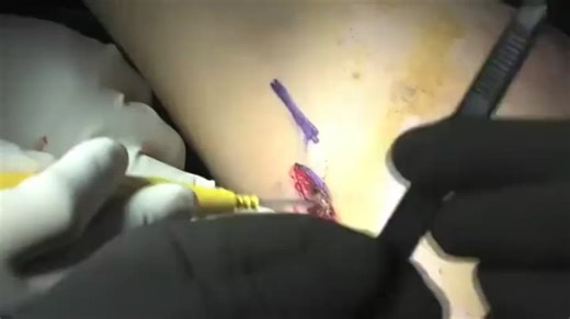 Subpectoral Biceps Tenodesis