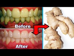 In just 4 Minutes, White Teeth Whiten And Shiny Like Pearls, This Recipe ! Teeth Whitening At Home