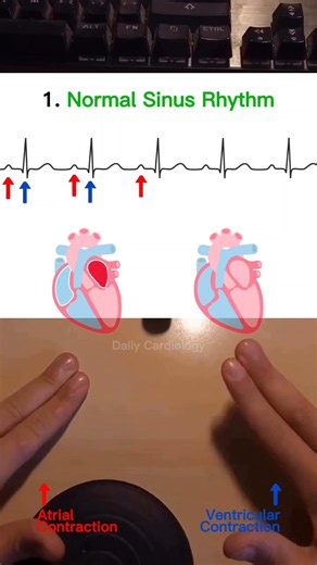 ECG interpretation made easy #ecg #ecginterpretation #heartblock #atrialfibrillation #cardiology