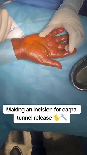 Making an incision for carpal tunnel release🖐️🔧 Carpal Tunnel Release is a surgical procedure used to relieve pressure on the median nerve 📏, which runs through the wrist in a narrow passageway called the carpal tunnel. When this nerve gets compressed, it can cause pain, numbness, and tingling in the hand and fingers 🖐️. The surgery is done to cut the transverse carpal ligament, freeing up space and reducing pressure. 🛠️✂️ Open Surgery 🏥 A small incision is made in the palm to access and c